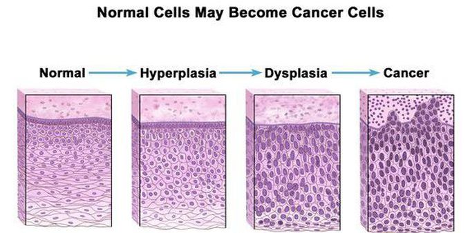 Dysplasia