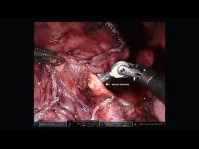 Robotic Left Upper Lobe Sleeve Lobectomy