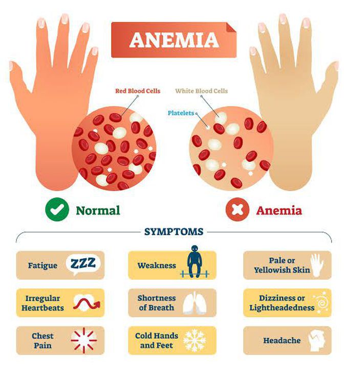 Iron deficiemcy anemia