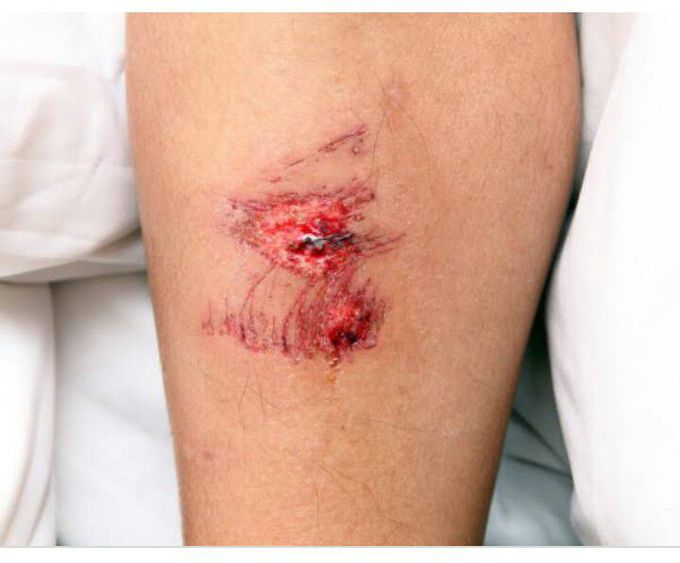 Wound Healing