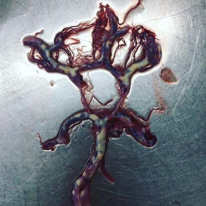 Circle of willis