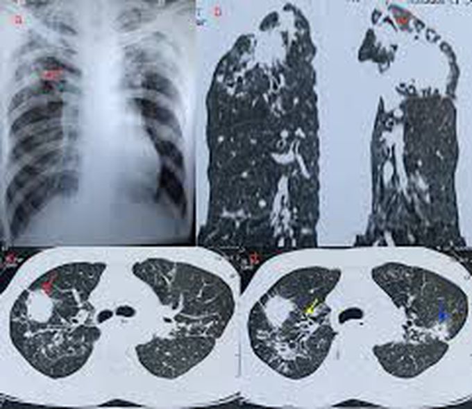 Causes of aspergillosis