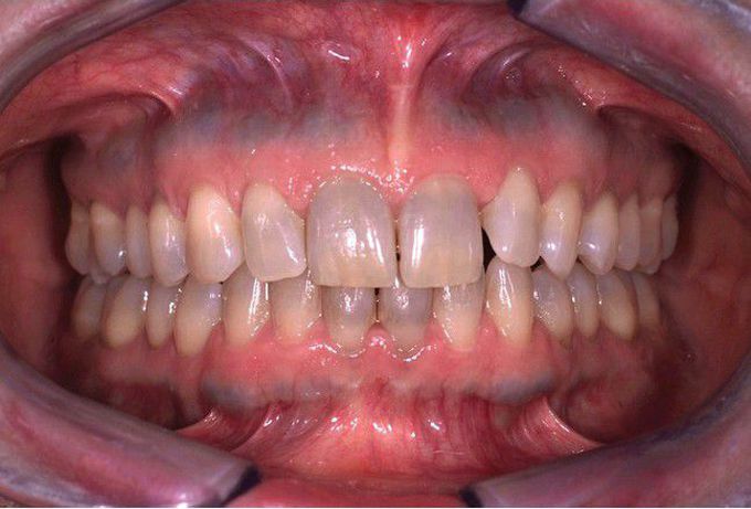 Minocycline related discolouration