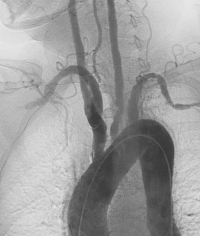 Takayasu arteritis