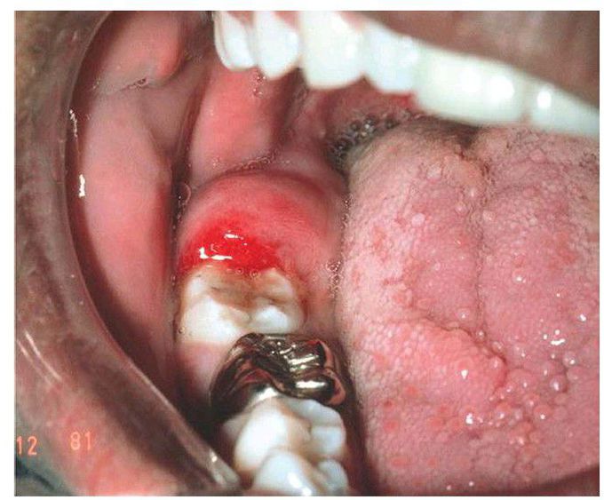 Pericoronitis