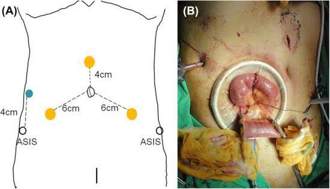 Cystectomy