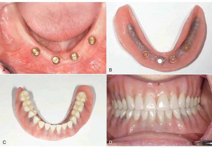 Implant supported denture