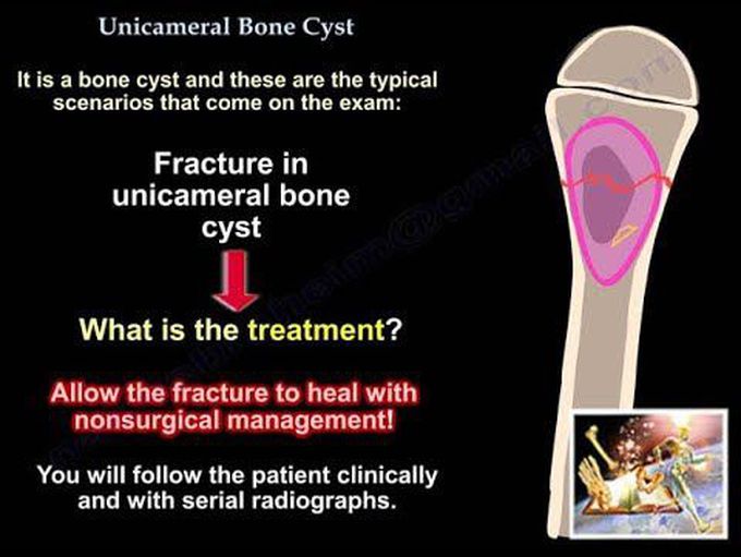 Bone Cyst ,Unicameral Bone Cyst - Everything You Need To Know - Dr. Nabil