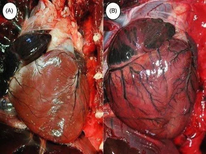 Normal VS heart with cardiomypathy! ⁠
⁠