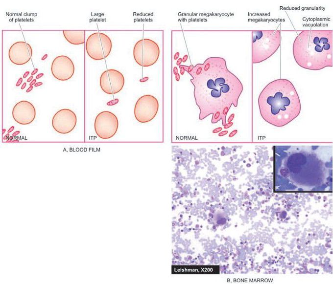 Idiopathic thrombocytopenic purpura