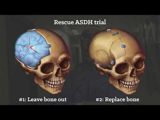 Rescue ASDH trial with Mr. Chris Uff