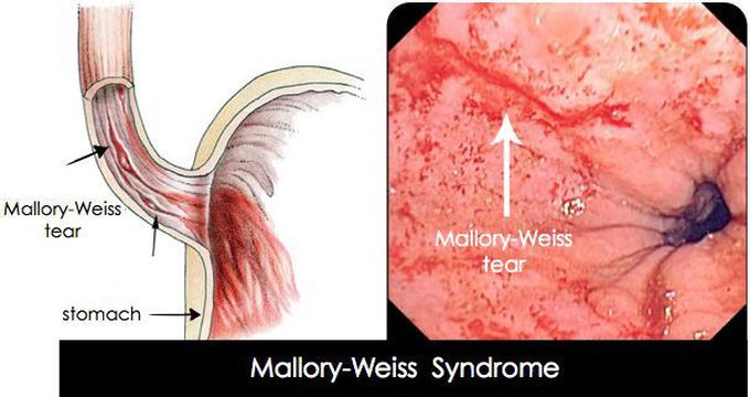 Mallory-Weiss Syndrome