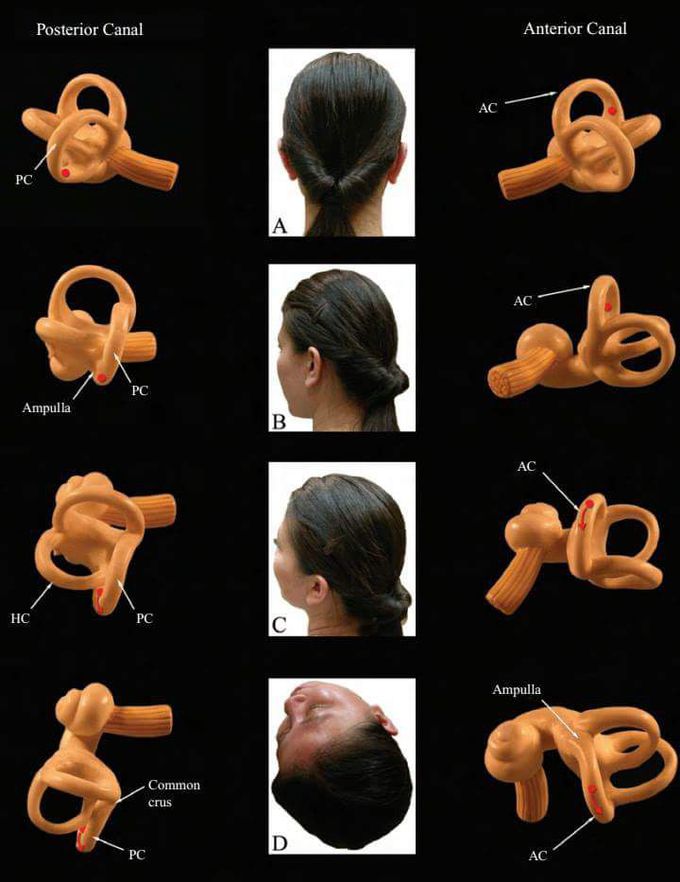 disease dizzy posture benign drama phát- bppv concept bppv - MEDizzy