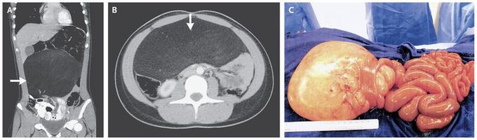 Constipation Associated with a Lipoma