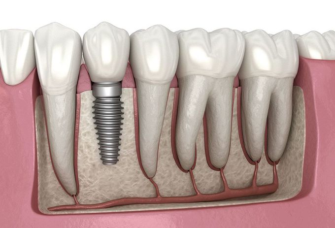 What are dental implants?