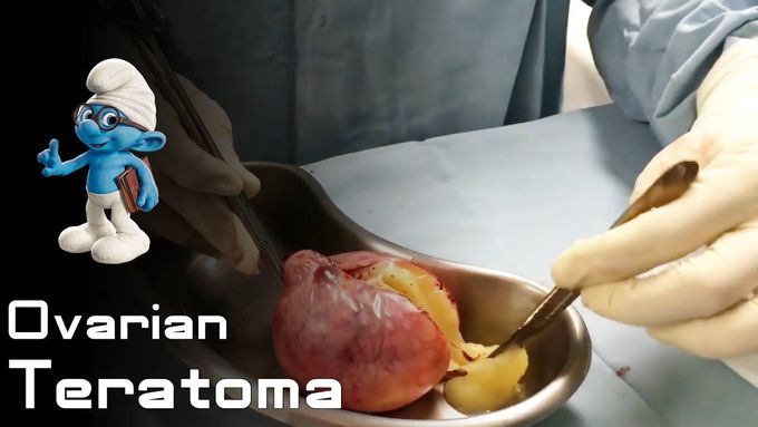 Excision of an Ovarian teratoma