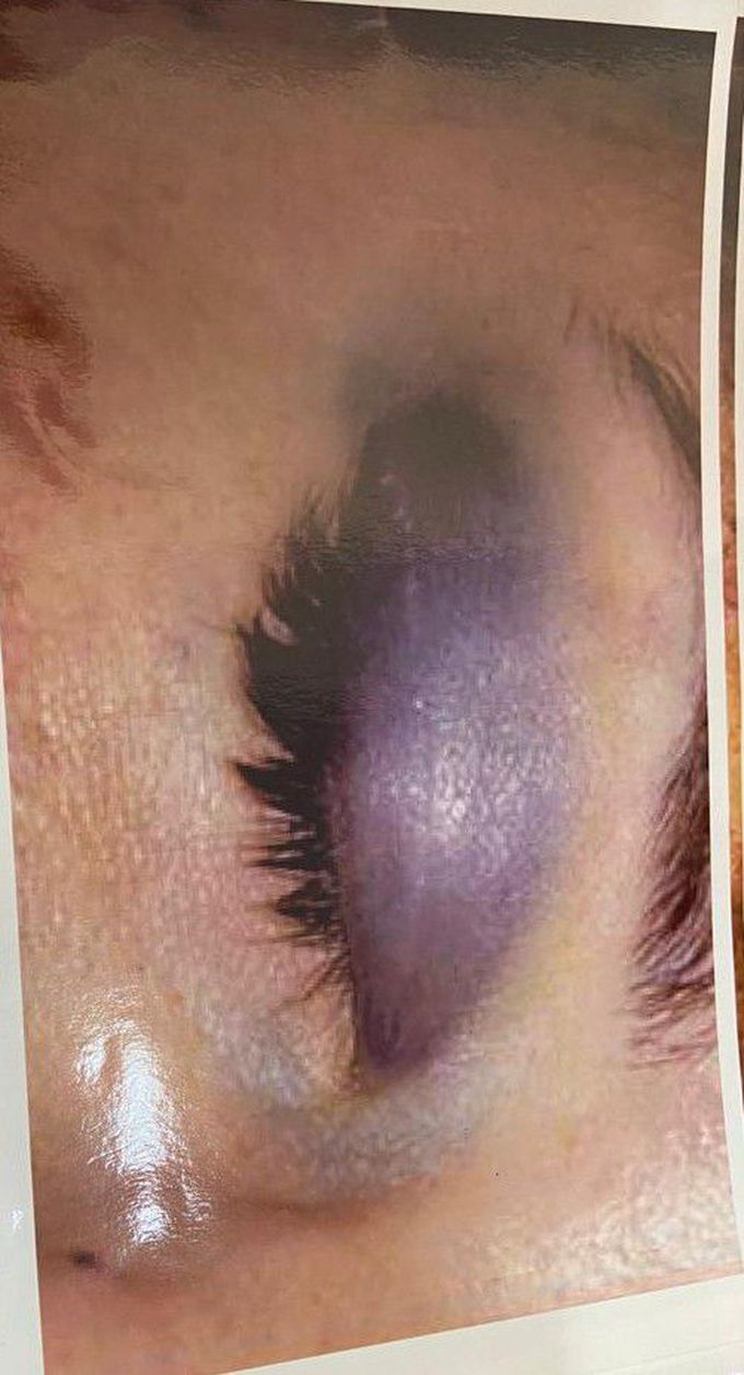 Black eye