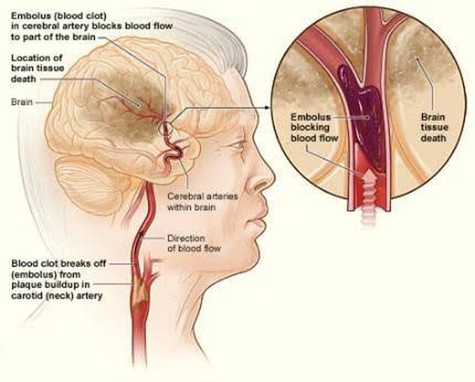 Causes of stroke