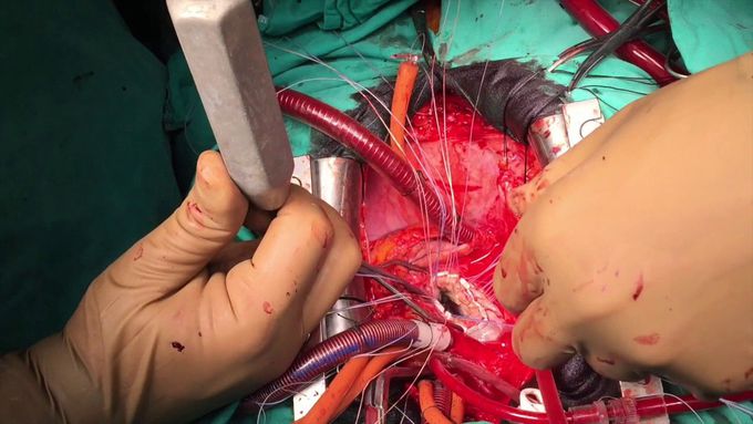 Mechanical Mitral Valve Replacement