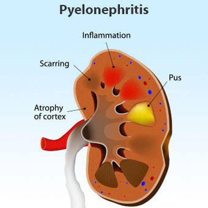 Pyelonephritis most common in women becuase short of urethra and no bactericidal prostatic fluid