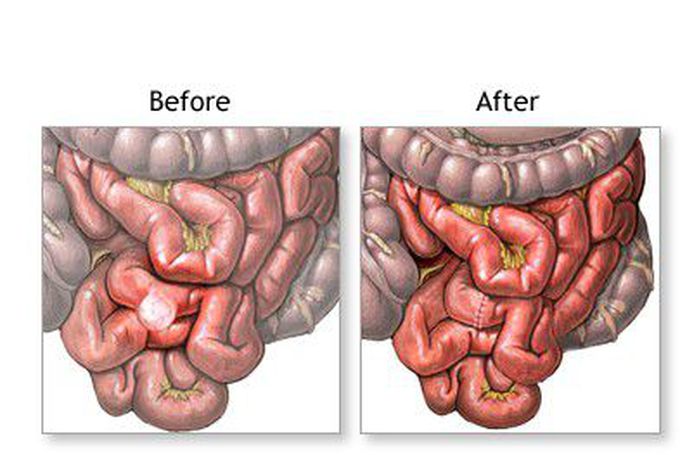 Treatment for Meckel's diverticulum