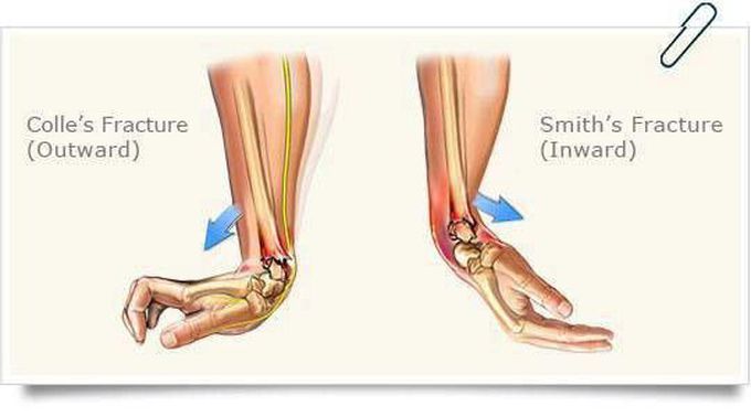 The difference between Smith's Fracture and Colle's Fracture