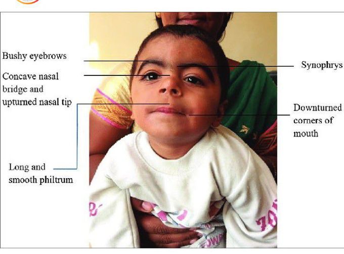 Identify the Syndrome