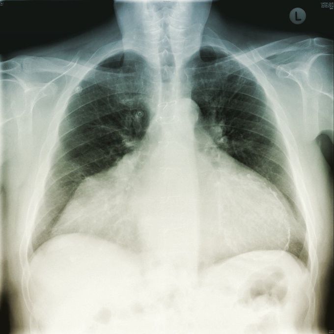 Heterotopic Heart Transplant