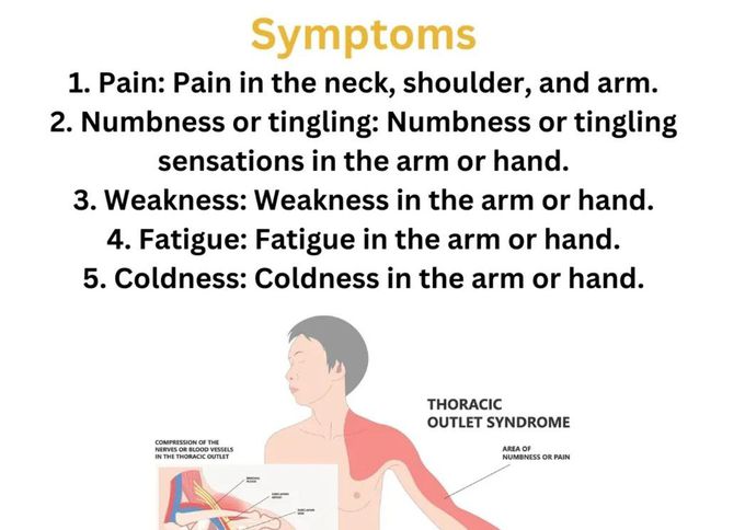 Thoracic Outlet Syndrome III