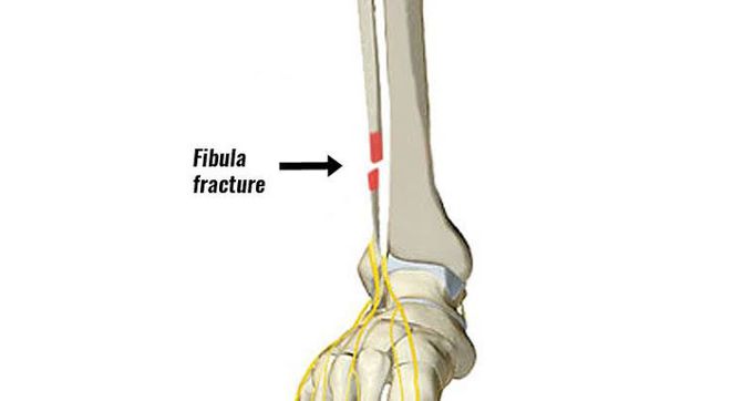 Fibular fracture