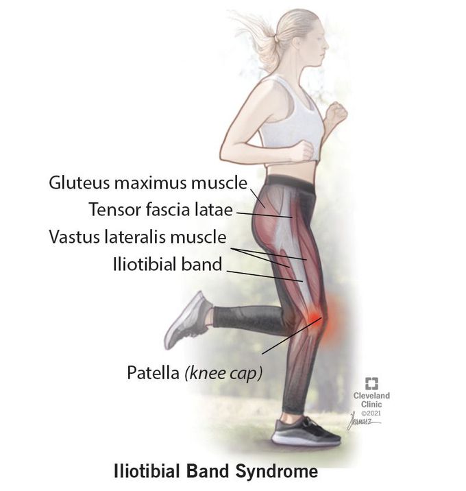 Illiotibial Band Syndrome