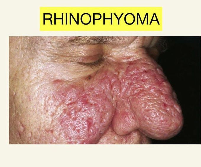 Rhinopyoma