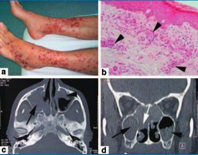 Churg strauss syndrome