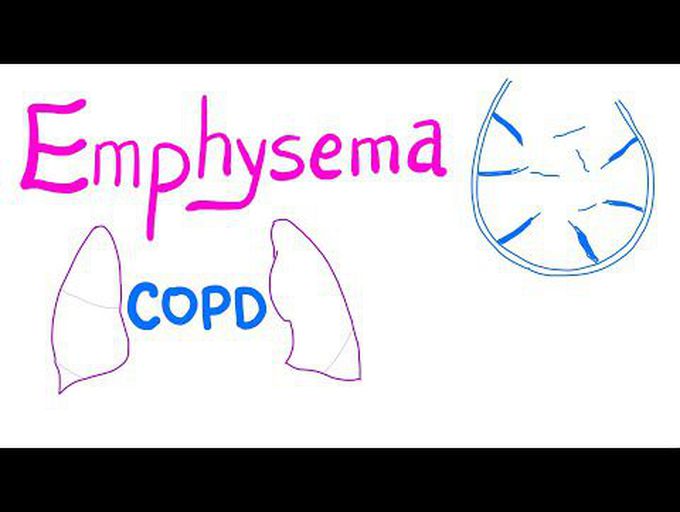 Emphysema | COPD | Pulmonary Medicine