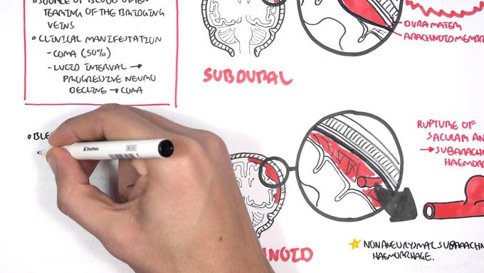 Intracranial Hemorrhage: Overview