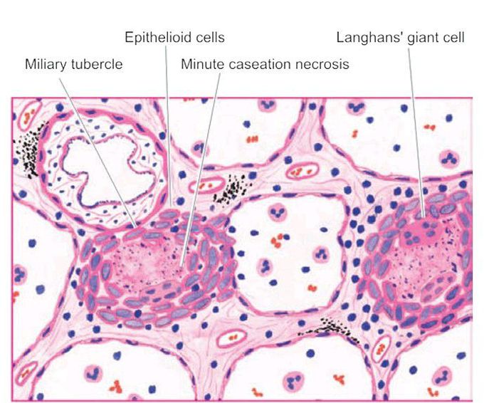 Miliary tuberculosis