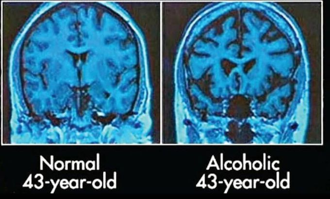 Normal Vs Alcoholic Brain