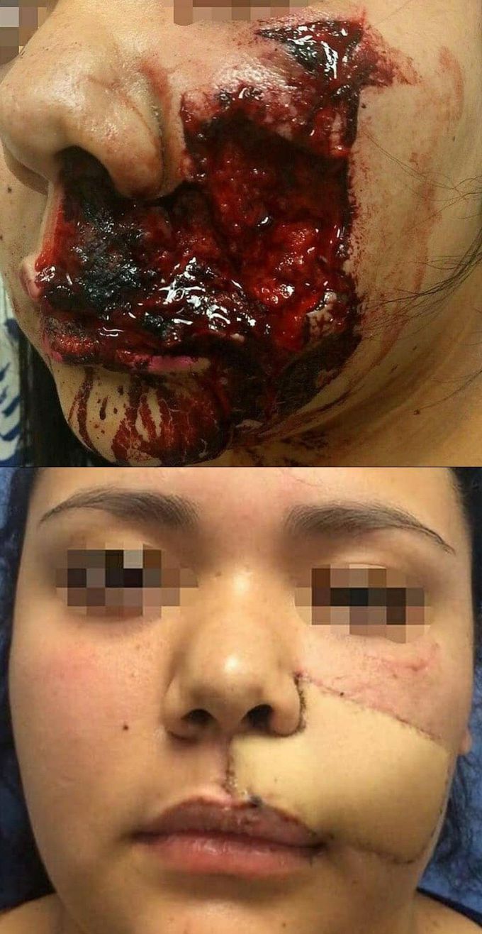 Dog attack again: This woman was attacked by a dog and suffered a bite in the facial area. As usual, when the repair was done with a free flap, the patient's forearm was used for the transplant.