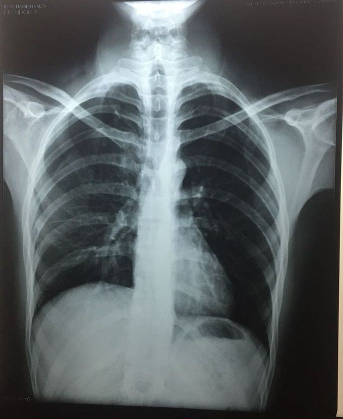 Interpret the X ray