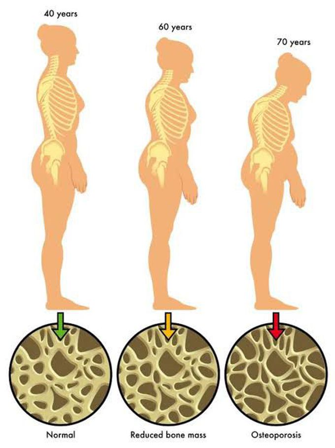 causes of osteopororsis