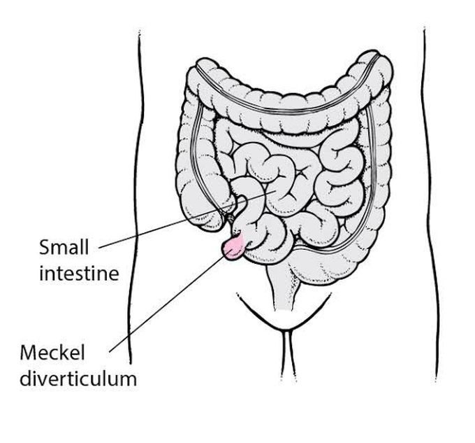 Meckel's Diverticulum