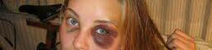 Black eye