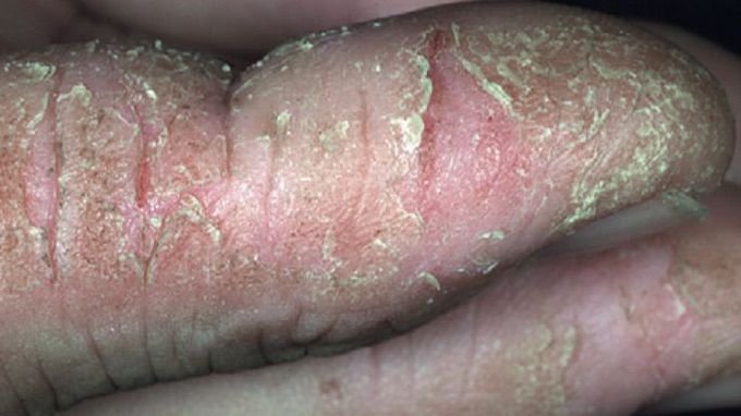 Fingertip eczema