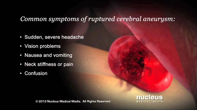 Cerebral Aneurysm