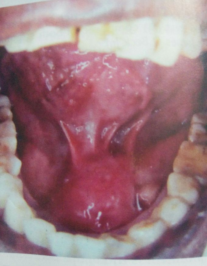 Epidermoid cyst