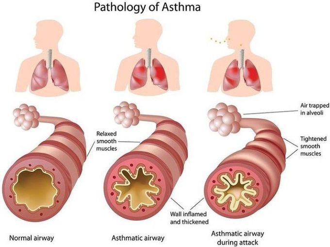 Pathology of Asthma