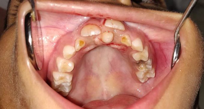 Supernumerary tooth