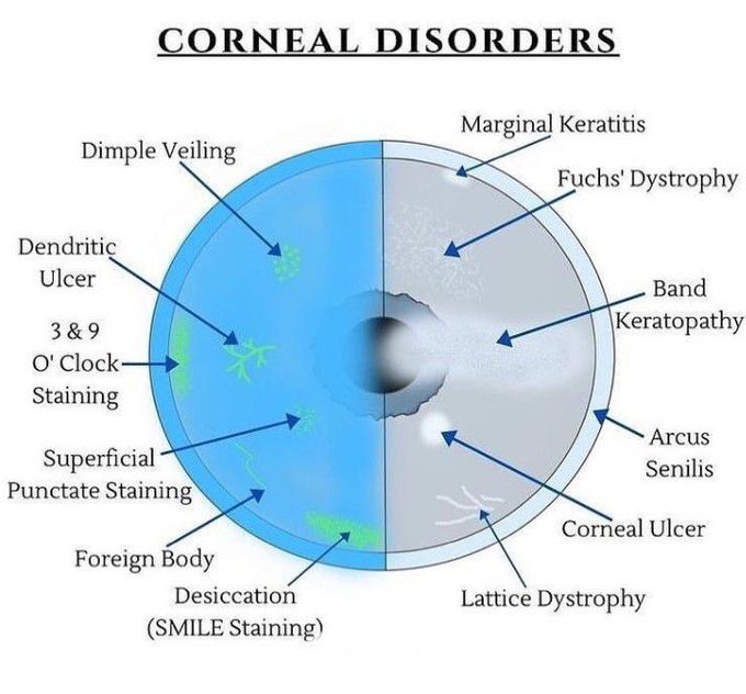 Corneal disorders