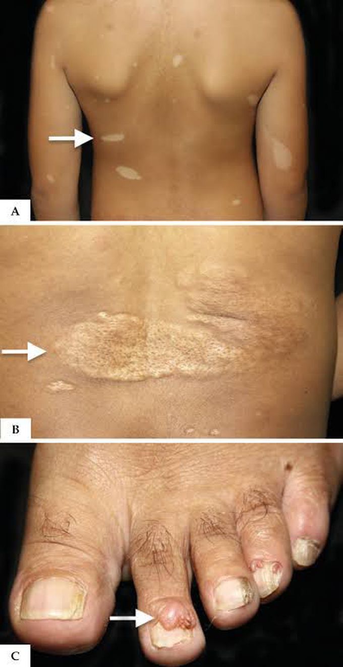 Tuberous sclerosis