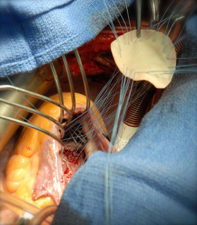 Repair of Ventricular Sepal Defect